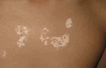 白癜风发病症状特点是什么 白癜风发病症状特点是什么.jpg