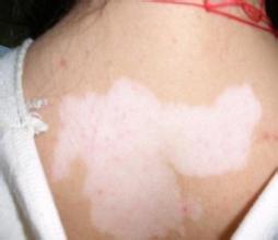 白癜风患者不可以多喝酒吗 白癜风患者不可以多喝酒吗.jpg