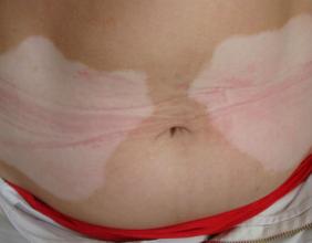 冬季白癜风患者需要注意什么呢 冬季白癜风患者需要注意什么呢.jpg