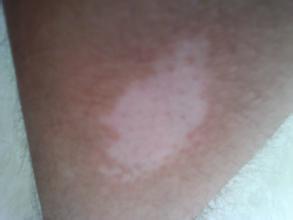 白癜风不治疗会有什么危害 白癜风不治疗会有什么危害.jpg